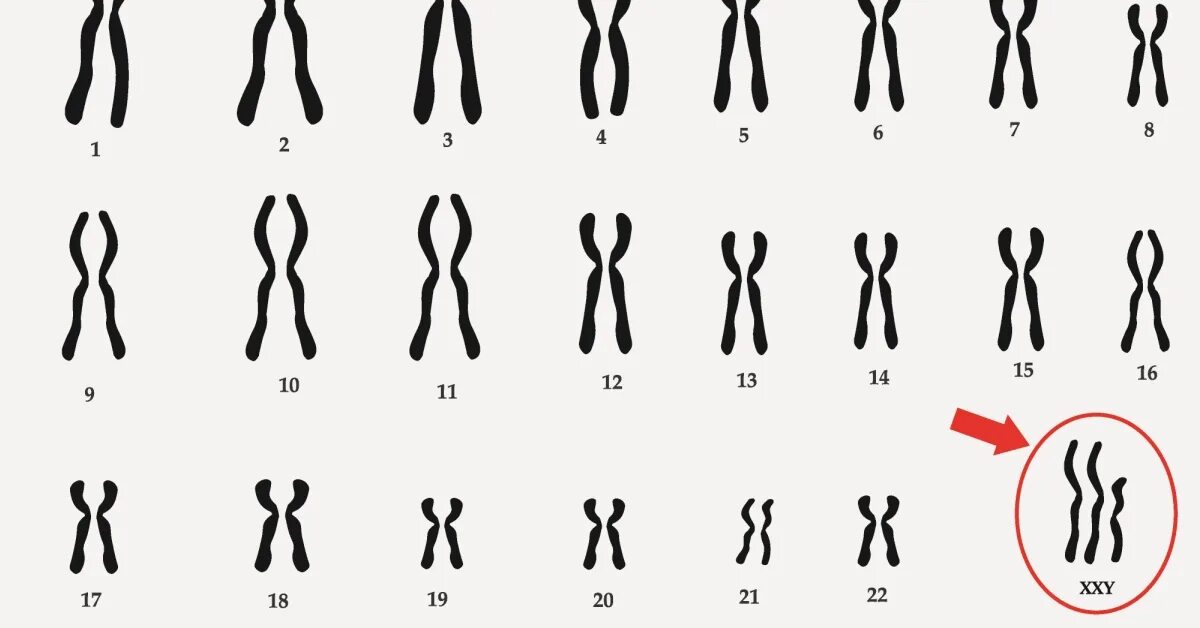 Икс хромосома и игрек хромосома. Кариотип при синдроме клайнфельтера. Xx xy хромосомы. Синдром тернера хромосомный набор. Трисомия х хромосомы у женщин.