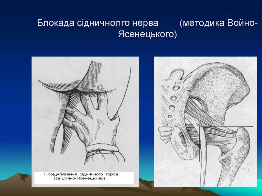 Нервная блокада. Техника блокады седалищного нерва по Войно-Ясенецкому. Блокада седалищного нерва по Войно-Ясенецкому. Блокада по Войно Ясенецкому. Методика блокады бедренного нерва.