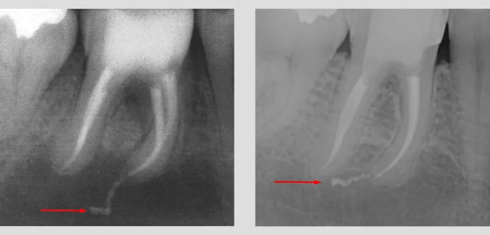 Воспаление канала зуба. Гранулирующий периодонтит рентген. Пломбировка каналов зуба рентген. Периодонтит радиовизиография.