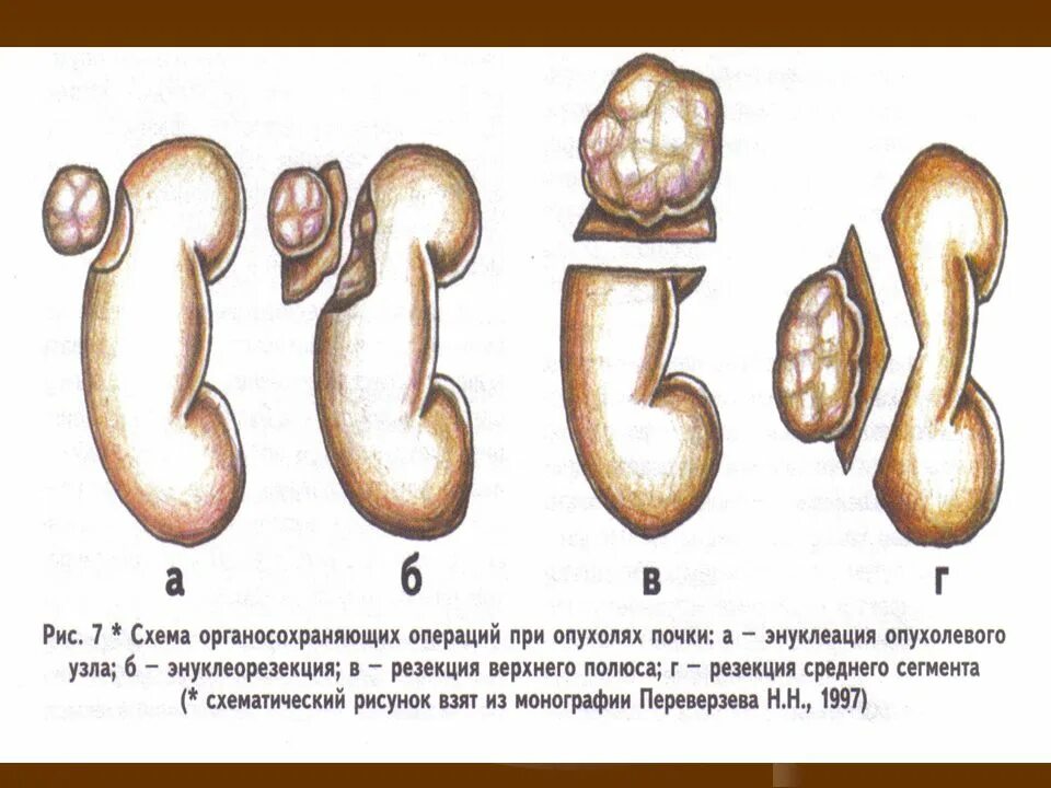 Опухоль верхнего полюса почки. Резекция опухоли почки. Операции при опухоли почки.