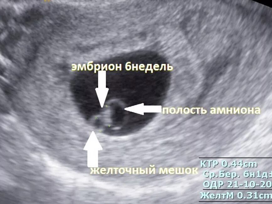 Можно ли в 6 недель. Узи плодного яйца на 5 неделе беременности. узи плодное яйцо 6 недель. пя 9.9 мм желточный мешок 1.1 мм анэмбриония.