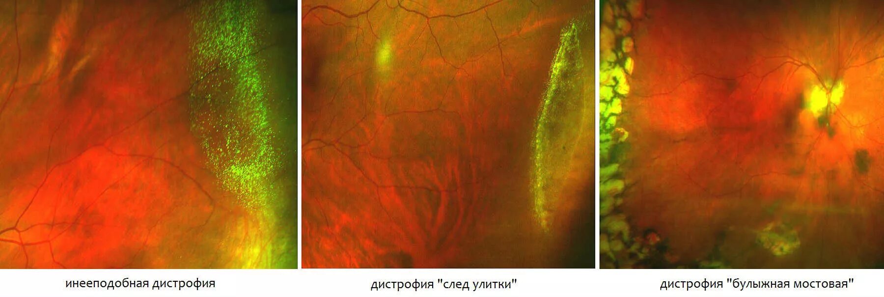 Периферические ретинальные дегенерации. Дегенерация сетчатки по типу булыжной мостовой. Инееподобная дистрофия сетчатки. Инееподобная дегенерация сетчатки. Решетчатая дистрофия сетчатки.