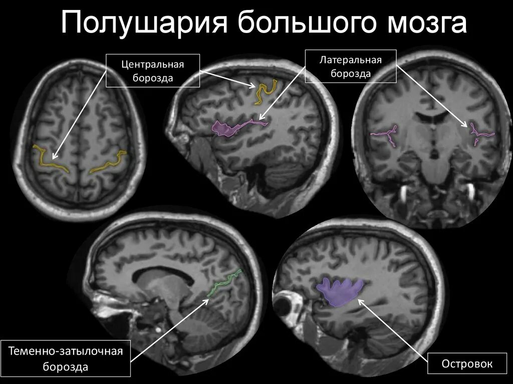 Доли мозга мрт. Мрт анатомия головного мозга аксиальные срезы. Граница лобной и теменной долей на кт. Лобные извилины мрт анатомия. Мрт головного мозга аксиальный срез.