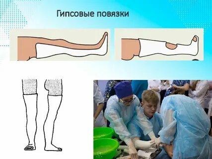 Как правильно гипс