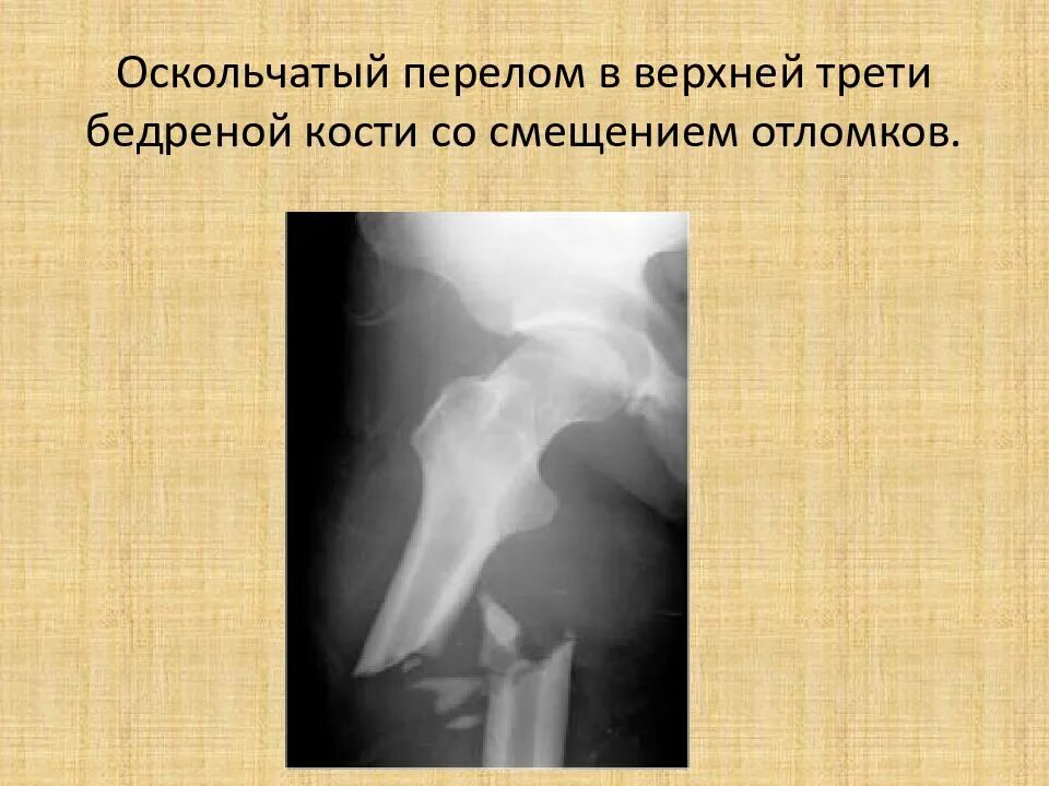 Оскольчатый перелом без смещения. Оскольчатый перелом кости. перелом диафиза бедренной кости. оскольчатый перелом бедренной кости. открытый оскольчатый перелом бедренной кости.