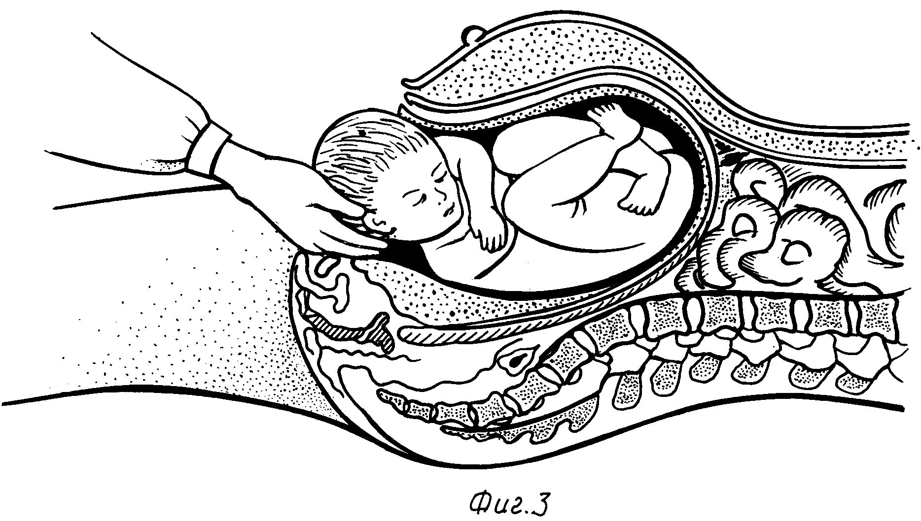 Кесарево сечение показания. Роды кейсеровосечение. Кесарево сечение извлечение плода. Кесарево сечение плода. Показания к операции кесарево сечение.