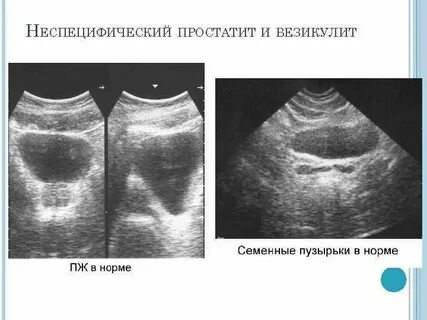 Воспаление семенных