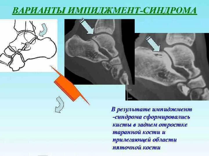 Синдромы голеностопного сустава. Импиджмент синдром голеностопного сустава. Импиджмент синдром голеностопного сустава рентген. Импинджмент синдром голеностопного сустава рентген. Импичмент синдром голеностопного сустава.