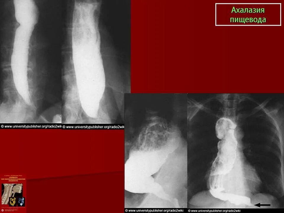 Ахалазия кардии пищевода рентген. Ахалазия кардии рентген. Халазия пищевода