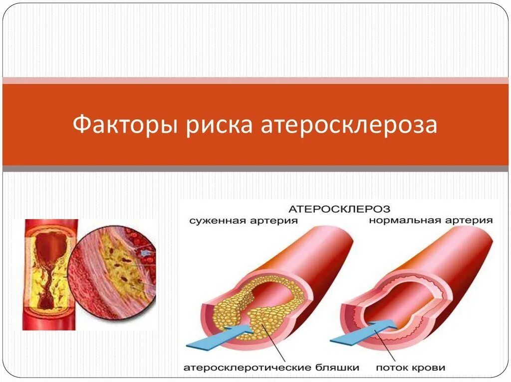 Факторытриска атеросклероза. Факторы риска атеросклероза. Что такое «атеросклероз»? Факторы риска атеросклероза. Факторы риска развития атеросклероза. Хроническое заболевание сосудов