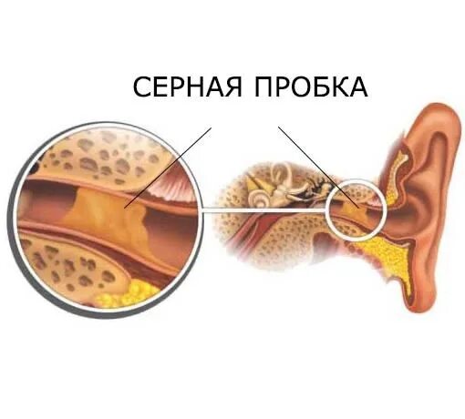 Как удалить серную пробку. Как удалить серную пробку