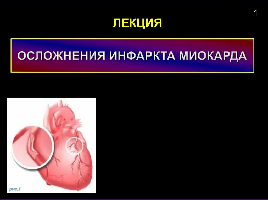 Осложнения инфаркта миокарда. Поздние осложнения инфаркта миокарда. Ранние осложнения инфаркта миокарда. Осложнения острого инфаркта миокарда. Частые осложнения инфаркта миокарда