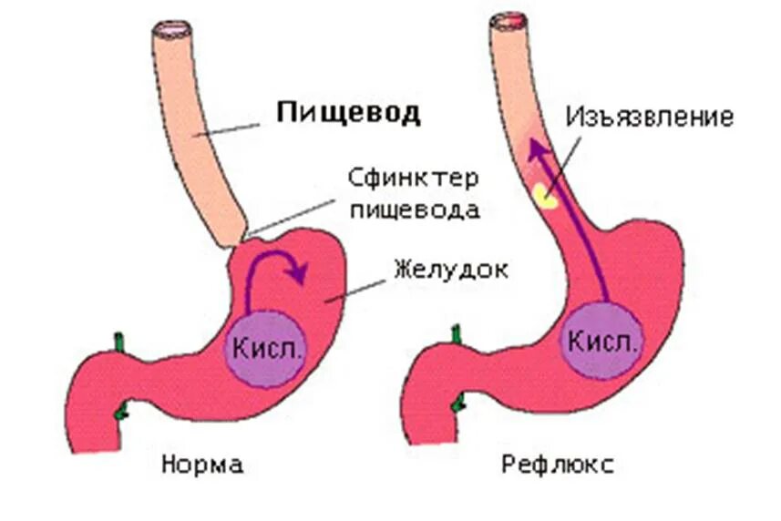 Постоянный рефлюкс. Рефлекс эзофагит рефлюкс. Дуоденальный гастрит рефлюкс. Гастрит рефлюкс эзофагит. Эндоскопическая картина рефлюкс эзофагита.