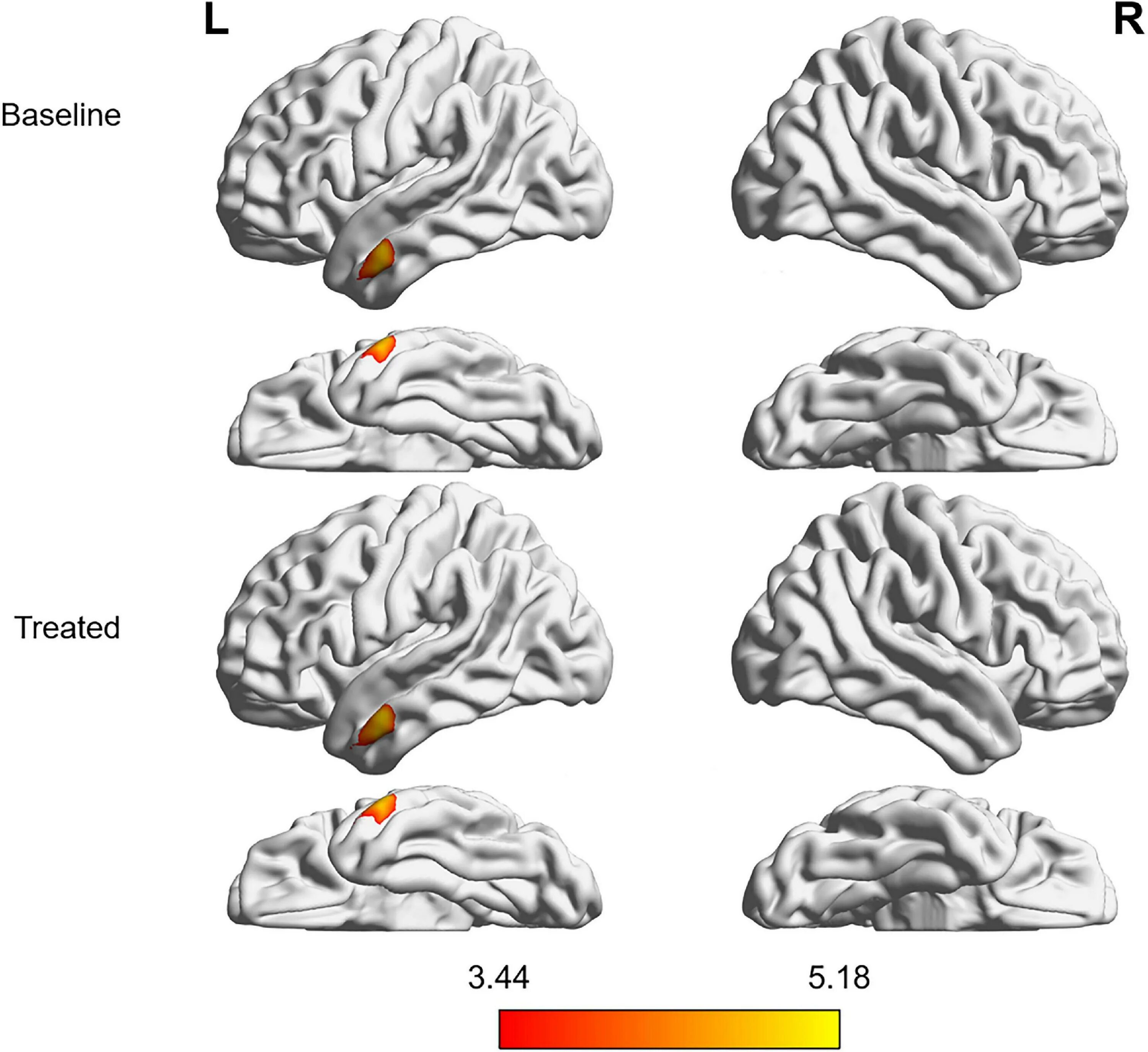 Афазия. Tinnitus Brain. Brain function nootrops.