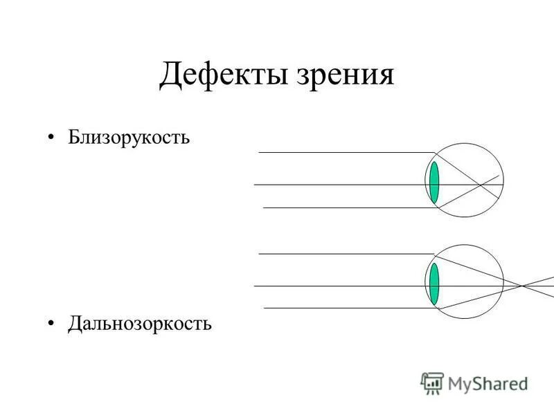 дефекты зрения это