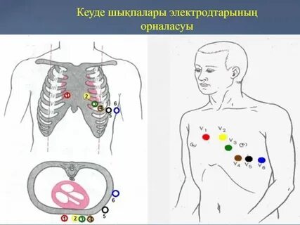 Наложение электродов при экг схема по цветам