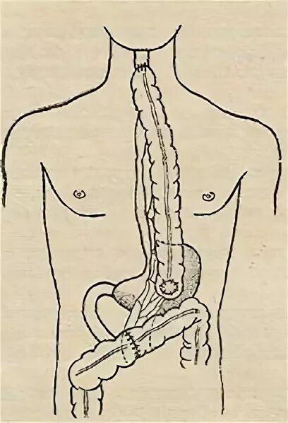 пластика пищевода по брайцеву. пищевод из толстой кишки. пищевод из толстой кишки. загрудинная субтотальная эзофагопластика толстой кишкой. тонкокишечная пластика пищевода.