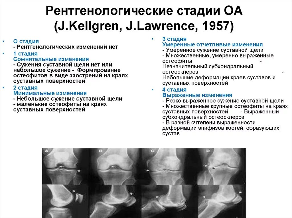 Рентген стадии остеоартроза. Классификация артроза коленного сустава рентген. Классификация рентгенологических стадий остеоартроза. Рентгенологические стадии остеоартроза (по a. Larsen, 1987):.