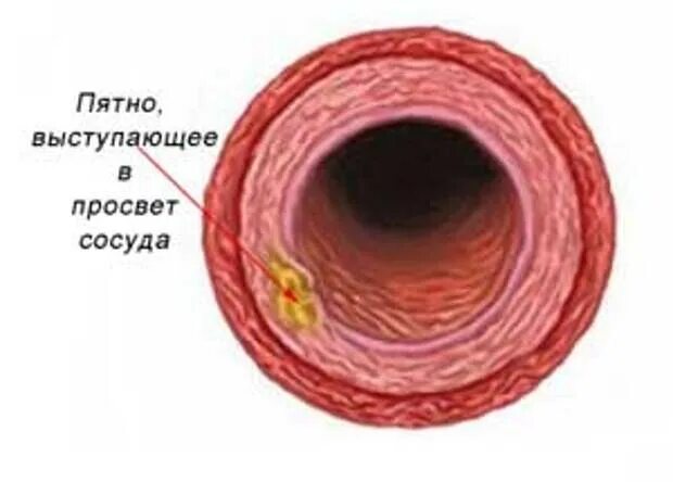 Артерий атеросклероз латынь. Атеросклероз 1 степени. Атеросклеротические отложения в сосудах. Морфогенез атеросклеротической бляшки. Первая стадия атеросклероза.
