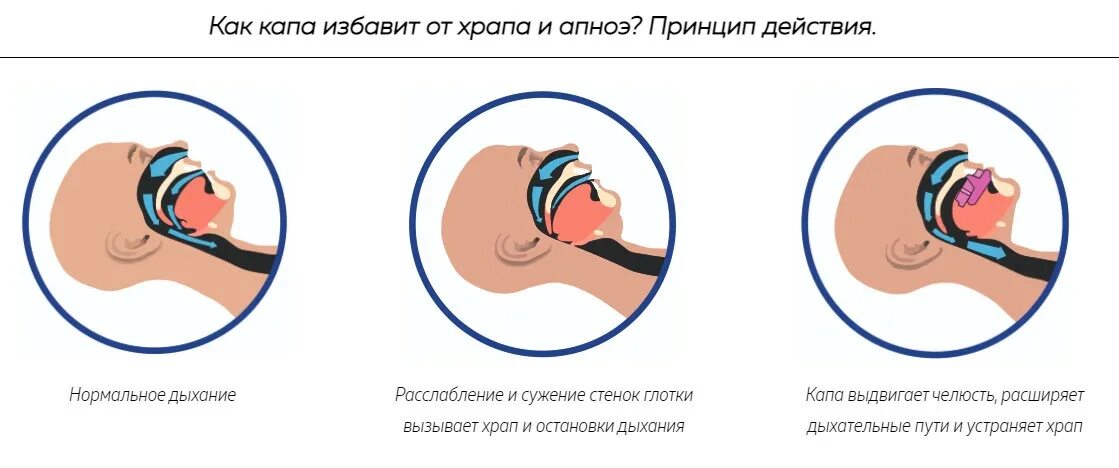 Можно ли избавиться от храпа. Чем опасен храп. капа от храпа как пользоваться. приколы про храп картинки. как избавиться от храпа женщине.