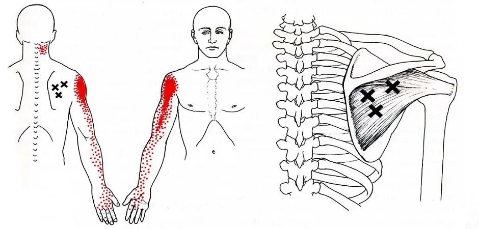 Подостная мышца триггерные точки. Триггерные точки в грудной мышце. Подлопаточная мышца триггерные точки. Триггерные точки при миозите грудной клетки.