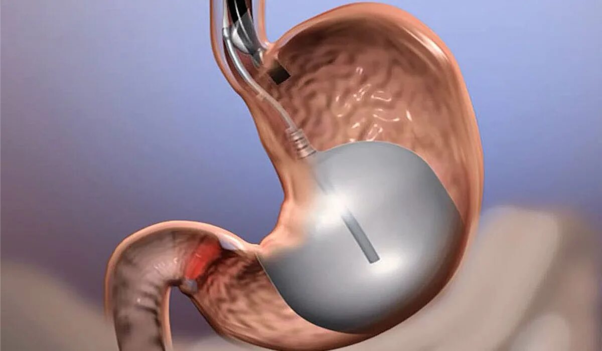 Внутрижелудочный баллон. Операция внутрижелудочный баллон. Операция по уменьшению желудка. Балансирование желудка. Еда стоит в желудке
