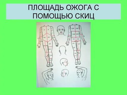 Карта ожогов