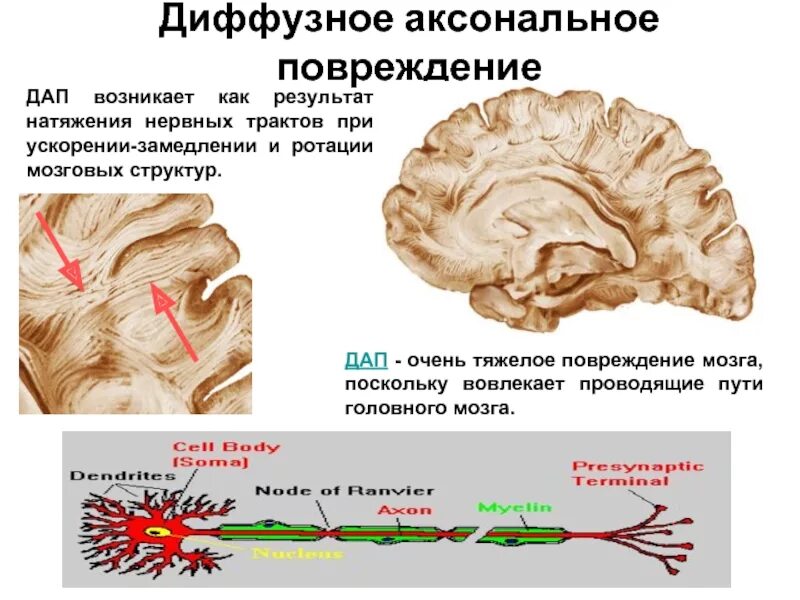 Диффузное аксональное повреждение. Аксональные повреждения головного мозга. диффузное повреждение аксонов. диффузное повреждение головного мозга. разрыв аксонов головного мозга.