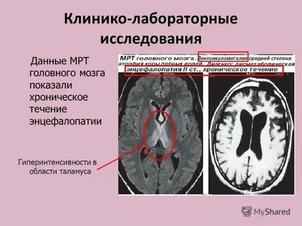 Энцефалопатия на мрт мозга