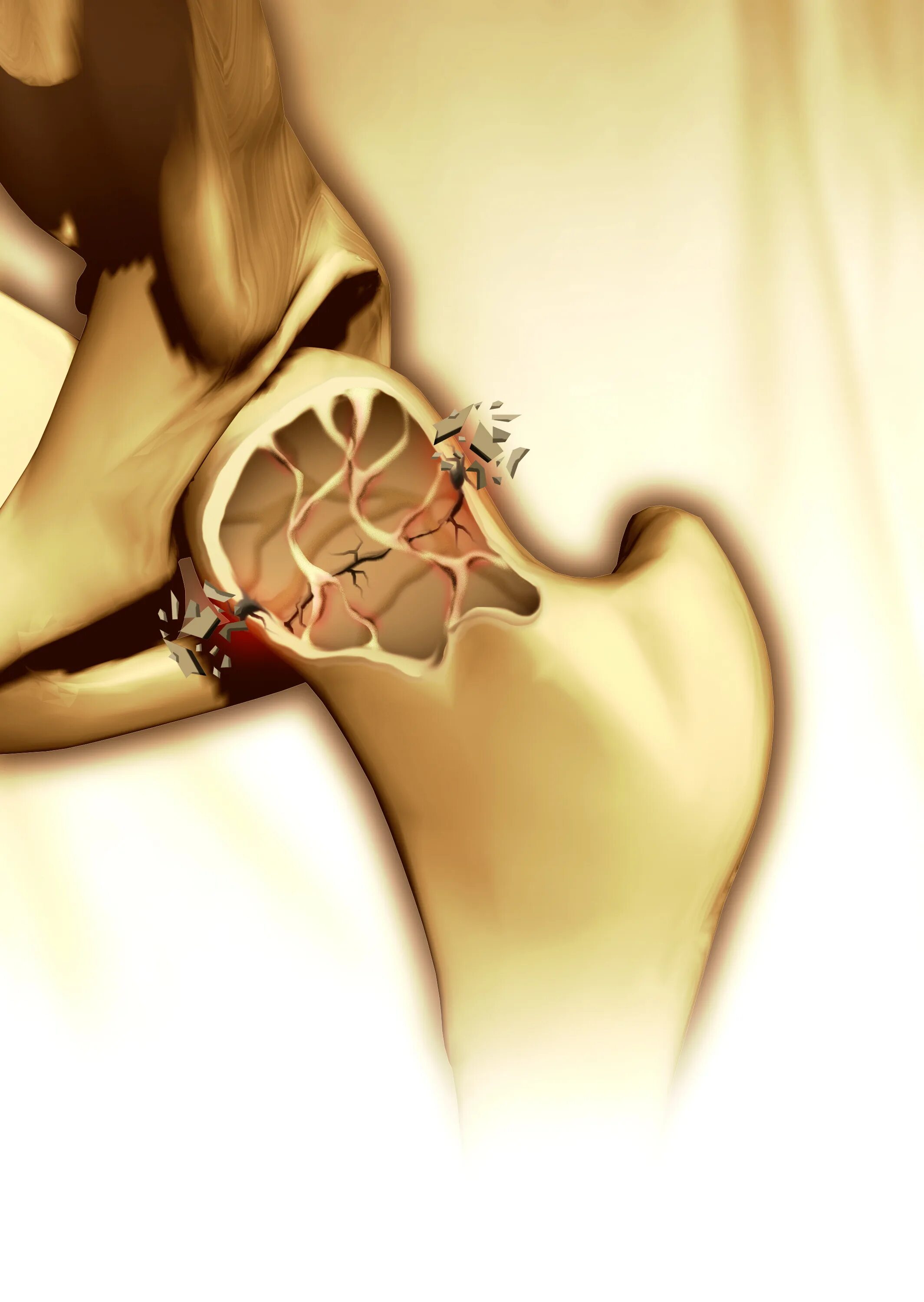 Разбивание костей. Остеопороз. Плотные кости. Fracture risk при остеопорозе.