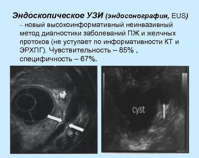 Эндоскопическая ультрасонография хронический панкреатит. Эндосонография двенадцатиперстной кишки. Эндосонография поджелудочной железы. Эндоскопическая ультрасонография при хронический панкреатит.