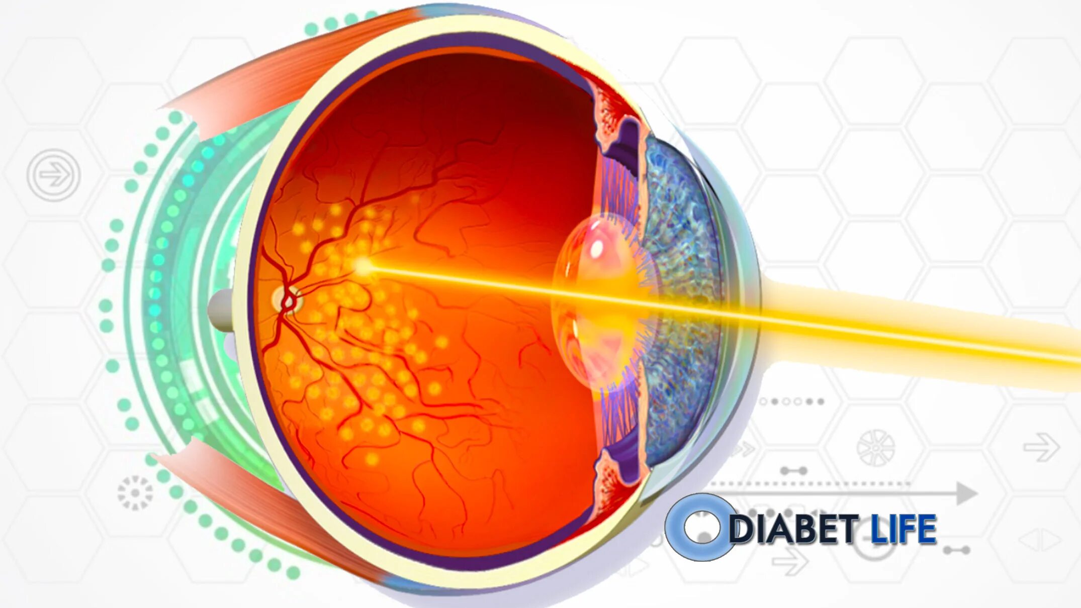 Диабетическая ретинопатия лазерная коагуляция. Периферическая профилактическая лазеркоагуляция сетчатки. Панретинальная лазерная коагуляция. Лазеркоагуляция сетчатки диабет.