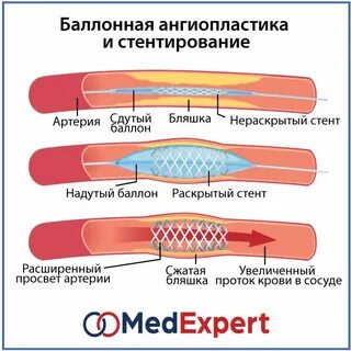 Баллонная ангиопластика