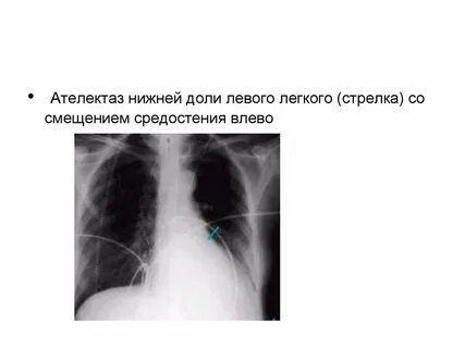 Ателектаз доли легкого
