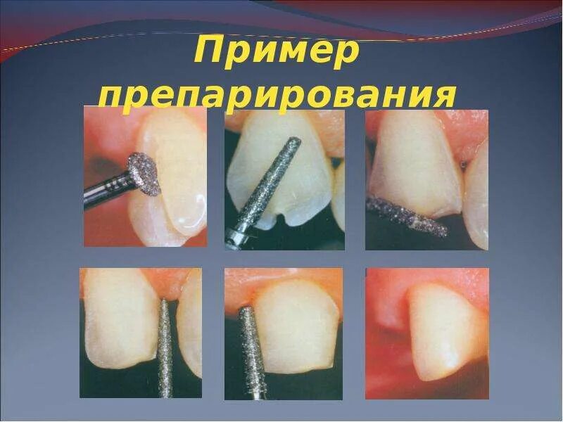Препарирование зуба под металлическую коронку. Препарирования под штамповонную керамику. метод препарирования под штампованную коронку. препарирование под металлическую штампованную коронку.