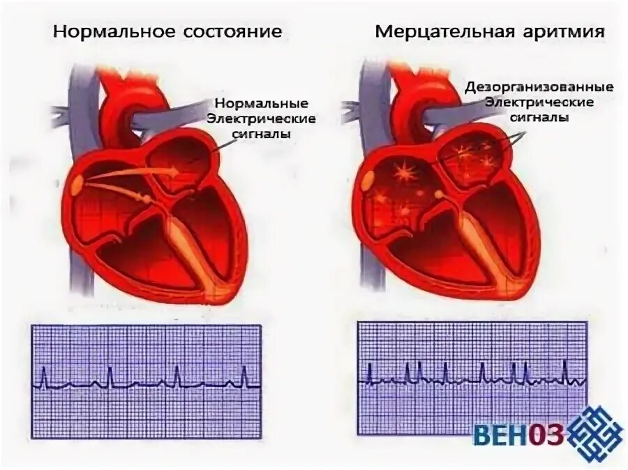 Красивое сердце Мерцательная аритмия. Аритмия сердца и курение. Симптомы мерцательной аритмии сердца у женщин. Опасна ли аритмия сердца для жизни.