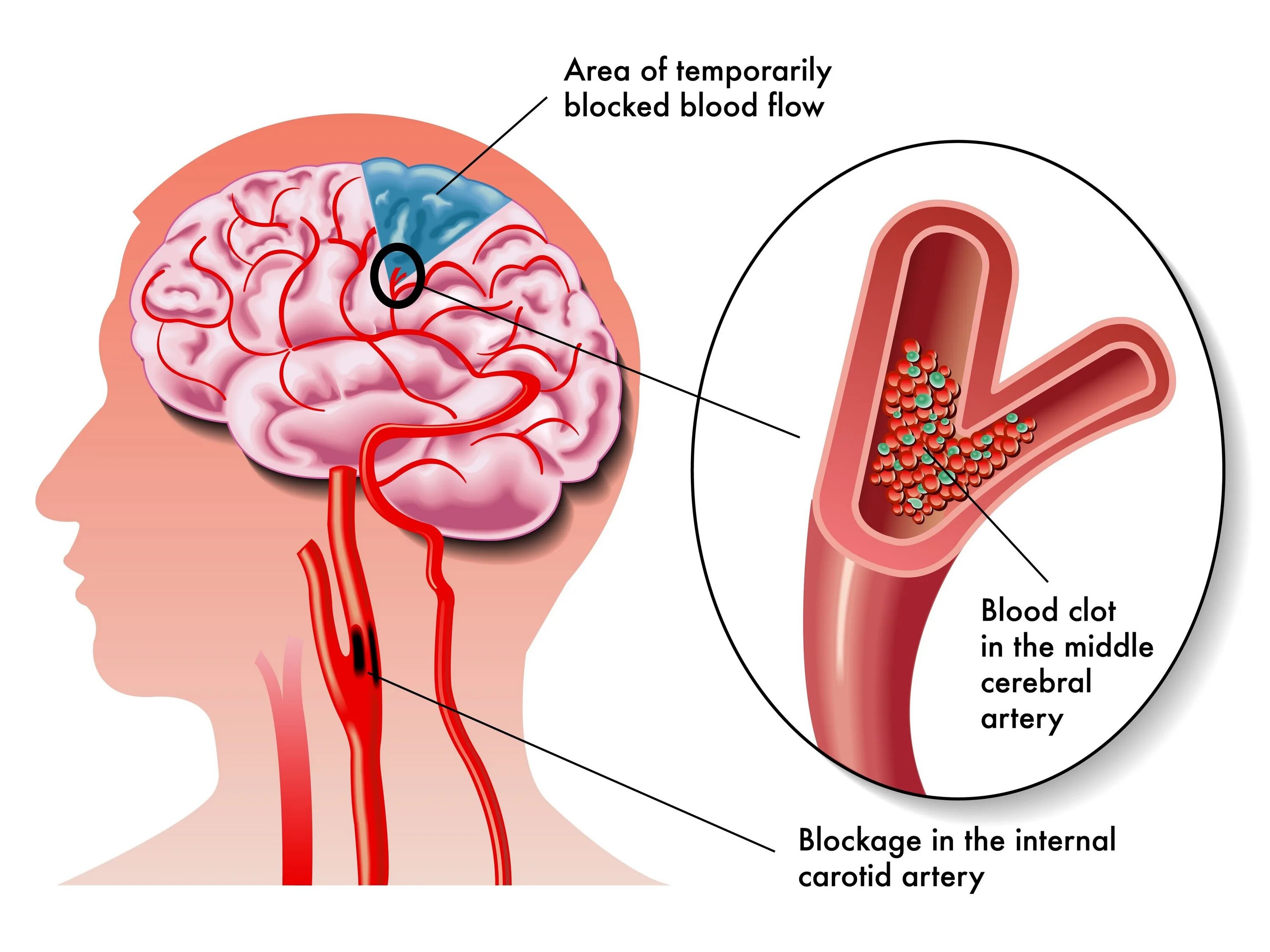 Сосудистые поражения мозга. Расширение сосудов головного мозга. Атеросклероз сосудов головного мозга. Атеросклероз мозговых артерий.