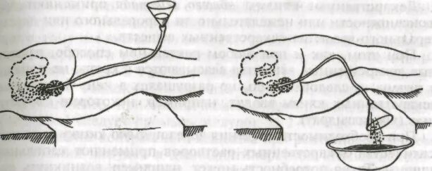 Постановка сифонной клизмы алгоритм. Сифонная клизма алгоритм. Сифонная клизма оснащение алгоритм. Сифонная клизма 20 литров. Как правильно вставить кишку