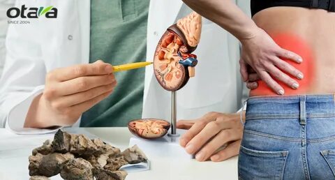 Стоит ли делать химический анализ почечного камня (конкремента)?