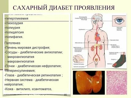 История болезни эндокринология сахарный диабет 2 типа