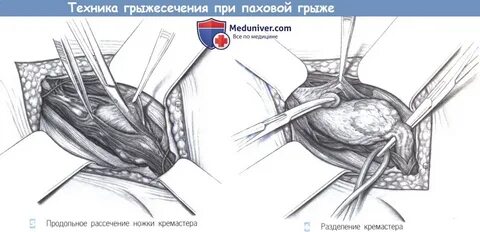 Паховая грыжа лечение