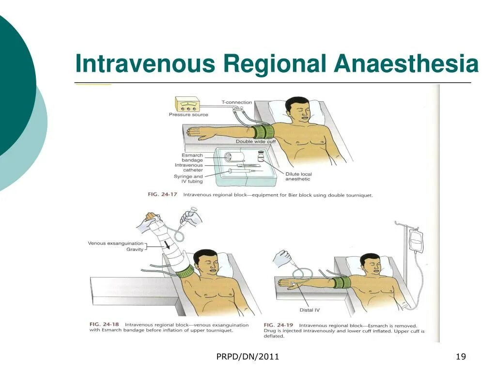 Intravenous концовки. Types of anesthesia. intravenous bier regional anesthesia.