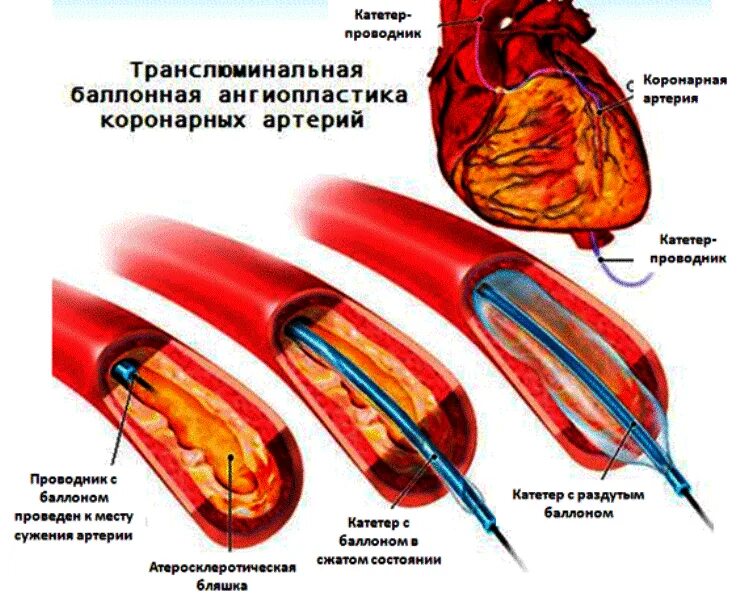 Расширяет коронарные сосуды