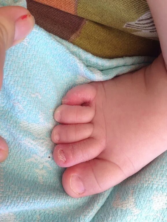 Пальчики на ножках у новорожденного. Пальцы на ногах у новорожденных. 6 Палец на ноге у новорожденного.