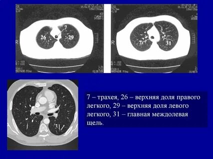 Кт правого легкого