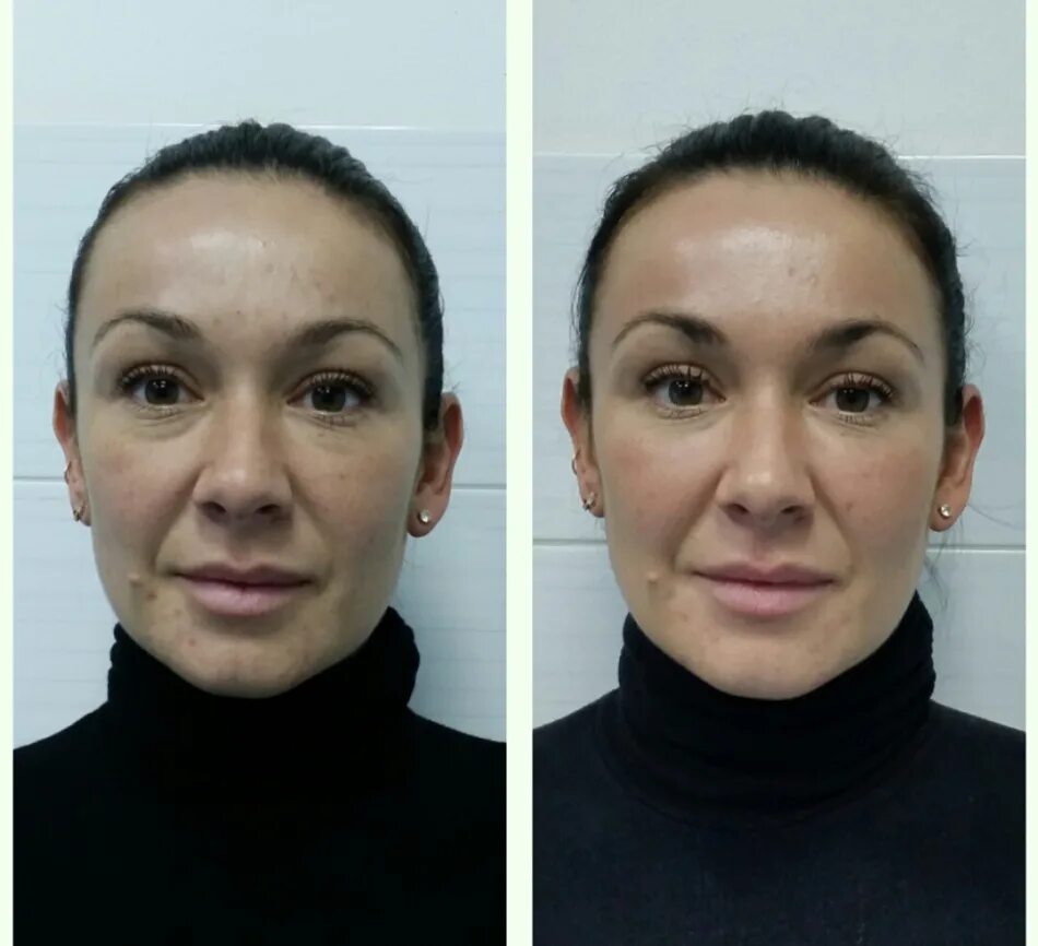 Иным образом улучшающий положение лица. Массаж лица до и после. лицо до и после массажа лица. моделирующий массаж лица до и после. омолаживающий массаж лица до и после.