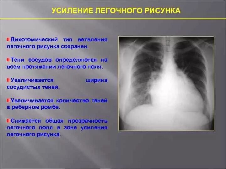 Усиление легочного рисунка. Патология легочного рисунка. Обеднение легочного рисунка. Усиленный легочный рисунок.