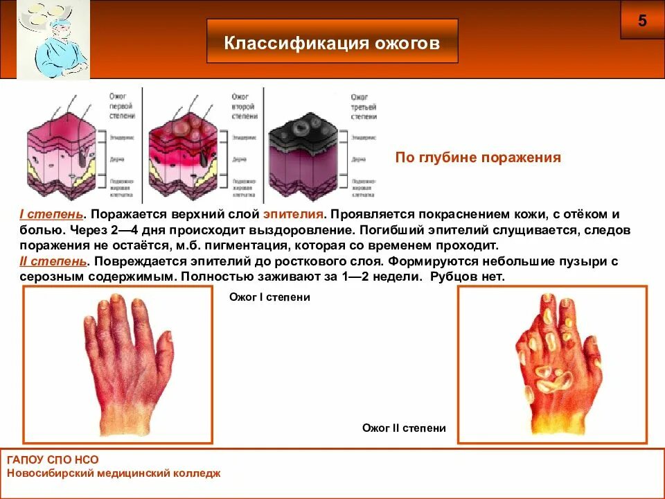 При термическом ожоге третьей степени. 4 Степени ожога таблица. Классификация ожогов по тяжести поражения. Таблица степени ожогов кожи.