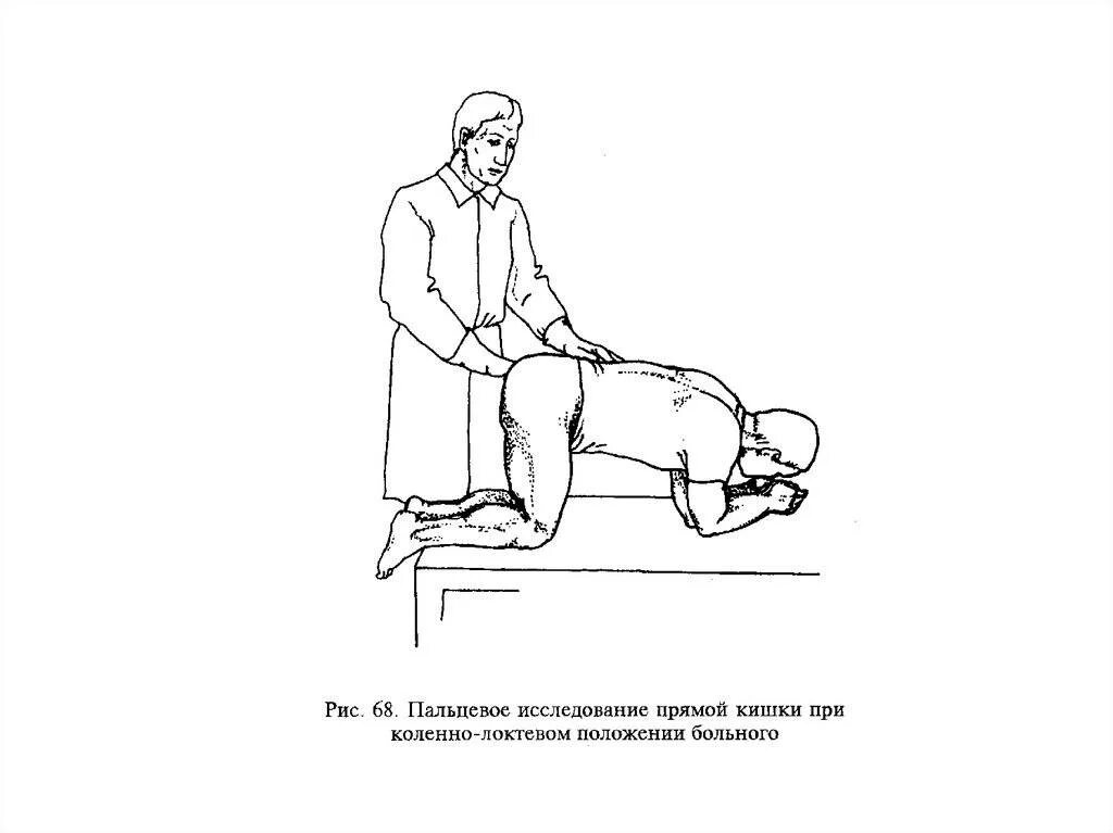 Пальцевое исследование прямой кишки положение пациента. Коленно-локтевое положение при беременности. Коленно локтевая поза при беременности. Коленно локтевая позиция при геморрое.