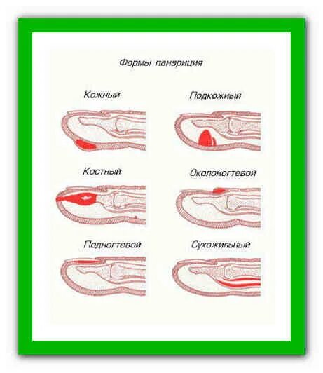 Панариций на одном и том же пальце - Вопрос детскому хирургу - 03 Онлайн